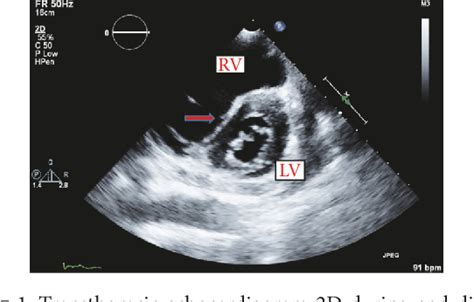 d shape lv|d shaped ventricle.